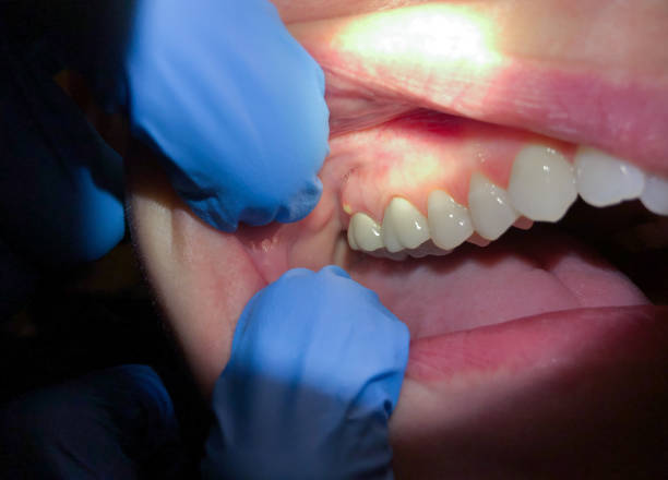 Best Emergency Denture Repair in Syracuse, UT